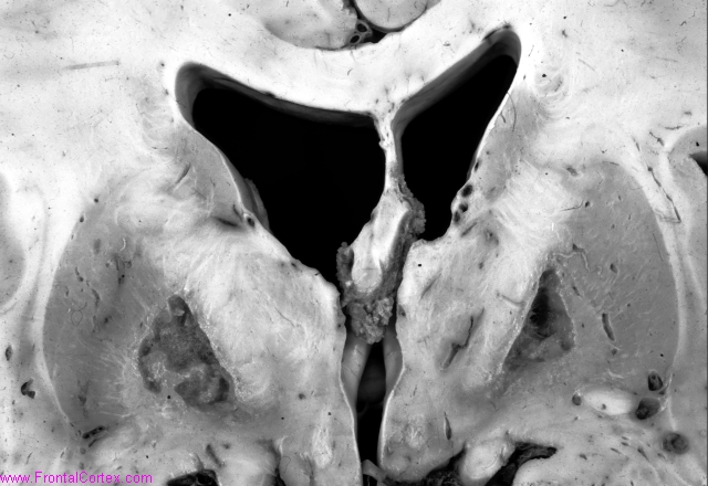 Bilateral pallidal necrosis with cavitation